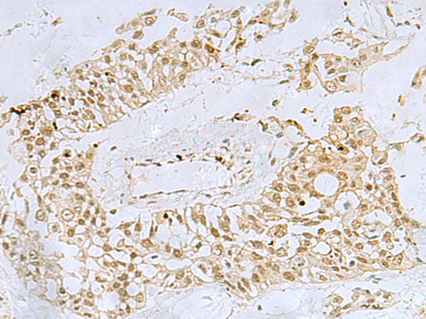 Immunohistochemistry of paraffin-embedded Human colorectal cancer tissue  using FOXQ1 Polyclonal Antibody at dilution of 1:30(×200)