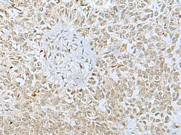 Immunohistochemistry of paraffin-embedded Human ovarian cancer tissue  using FOXQ1 Polyclonal Antibody at dilution of 1:30(×200)
