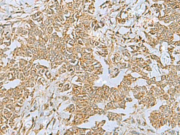 Immunohistochemistry of paraffin-embedded Human ovarian cancer tissue  using FAAP100 Polyclonal Antibody at dilution of 1:40(×200)