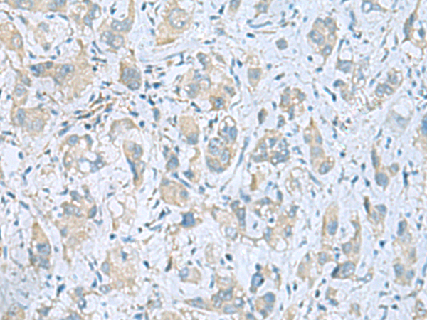 Immunohistochemistry of paraffin-embedded Human liver cancer tissue  using PLN Polyclonal Antibody at dilution of 1:45(×200)