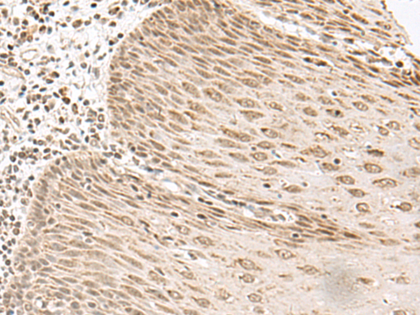 Immunohistochemistry of paraffin-embedded Human esophagus cancer tissue  using LGALS4 Polyclonal Antibody at dilution of 1:35(×200)