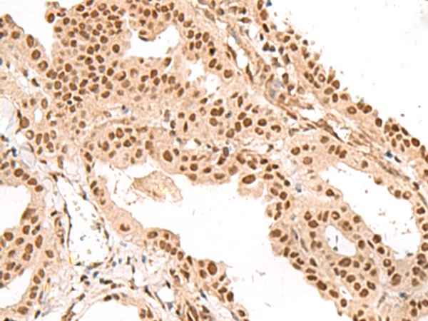 Immunohistochemistry of paraffin-embedded Human thyroid cancer tissue  using LGALS4 Polyclonal Antibody at dilution of 1:35(×200)