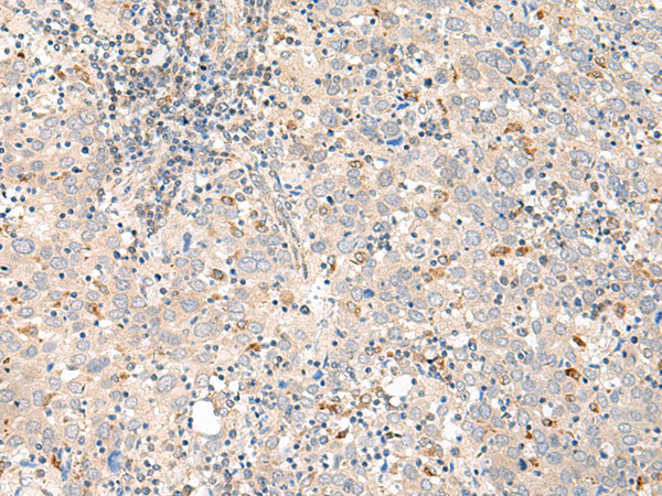 Immunohistochemistry of paraffin-embedded Human cervical cancer tissue  using GALR1 Polyclonal Antibody at dilution of 1:60(×200)