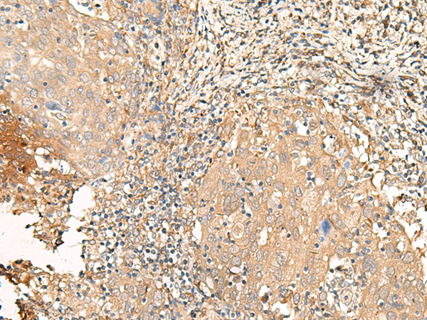 Immunohistochemistry of paraffin-embedded Human cervical cancer tissue  using GALR2 Polyclonal Antibody at dilution of 1:25(×200)