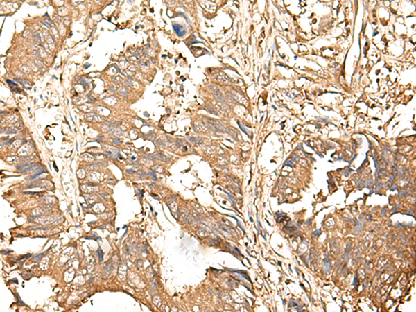 Immunohistochemistry of paraffin-embedded Human colorectal cancer tissue  using GALR2 Polyclonal Antibody at dilution of 1:25(×200)