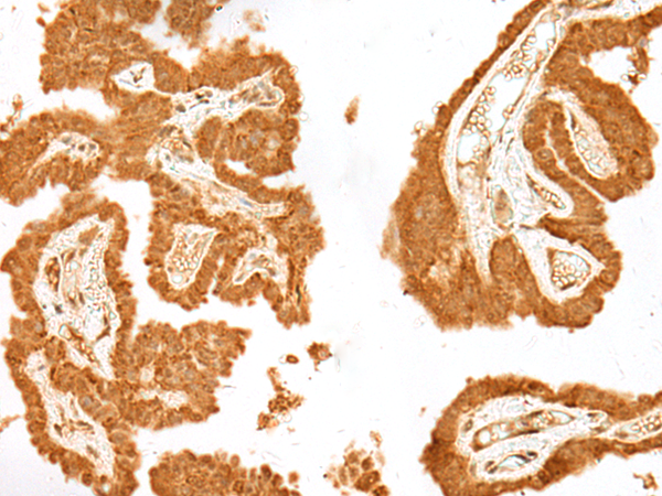 Immunohistochemistry of paraffin-embedded Human thyroid cancer tissue  using GANC Polyclonal Antibody at dilution of 1:55(×200)