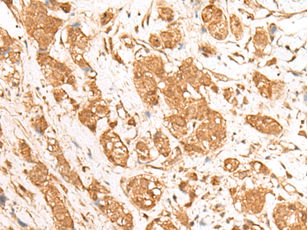 Immunohistochemistry of paraffin-embedded Human breast cancer tissue  using GANC Polyclonal Antibody at dilution of 1:55(×200)