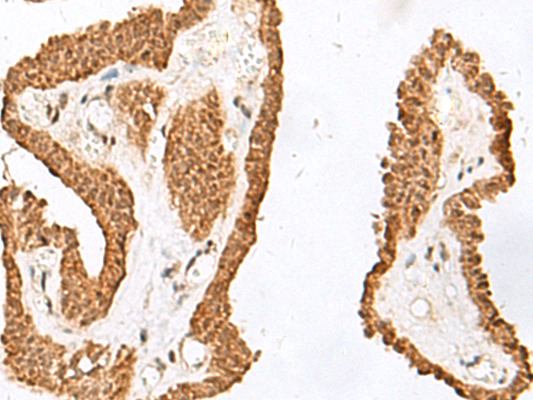 Immunohistochemistry of paraffin-embedded Human thyroid cancer tissue  using RALGAPA1 Polyclonal Antibody at dilution of 1:55(×200)