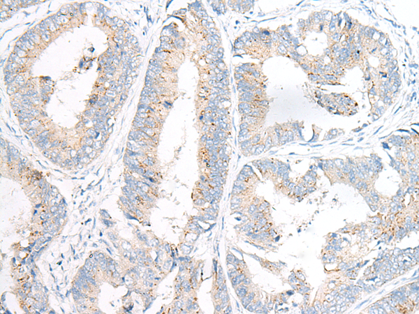 Immunohistochemistry of paraffin-embedded Human colorectal cancer tissue  using GARNL3 Polyclonal Antibody at dilution of 1:100(×200)