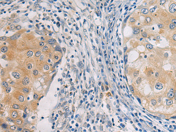 Immunohistochemistry of paraffin-embedded Human breast cancer tissue  using GBA Polyclonal Antibody at dilution of 1:55(×200)