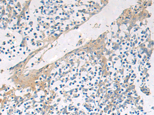 Immunohistochemistry of paraffin-embedded Human tonsil tissue  using GBA Polyclonal Antibody at dilution of 1:55(×200)