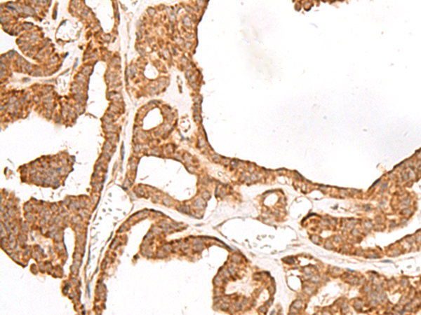 Immunohistochemistry of paraffin-embedded Human thyroid cancer tissue  using GBGT1 Polyclonal Antibody at dilution of 1:40(×200)