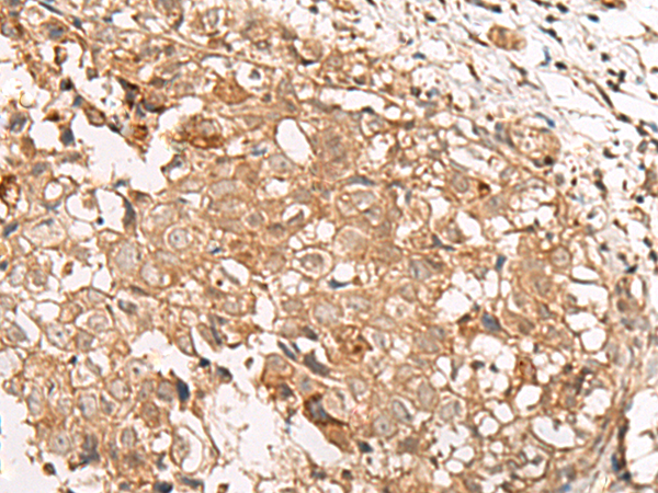 Immunohistochemistry of paraffin-embedded Human breast cancer tissue  using GBGT1 Polyclonal Antibody at dilution of 1:40(×200)