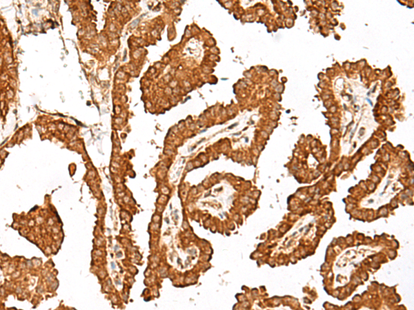 Immunohistochemistry of paraffin-embedded Human thyroid cancer tissue  using GBP4 Polyclonal Antibody at dilution of 1:45(×200)