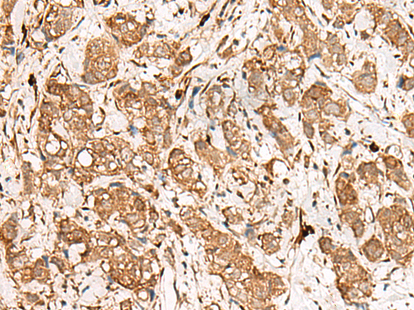 Immunohistochemistry of paraffin-embedded Human breast cancer tissue  using GBP4 Polyclonal Antibody at dilution of 1:45(×200)