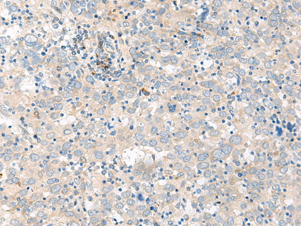 Immunohistochemistry of paraffin-embedded Human cervical cancer tissue  using GUCA1B Polyclonal Antibody at dilution of 1:45(×200)