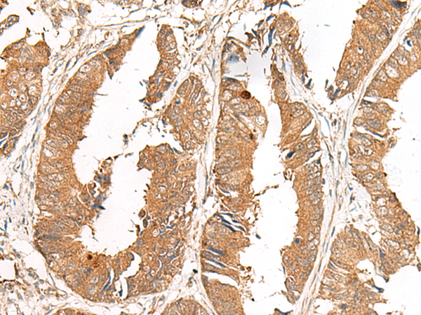 Immunohistochemistry of paraffin-embedded Human colorectal cancer tissue  using GCC2 Polyclonal Antibody at dilution of 1:50(×200)