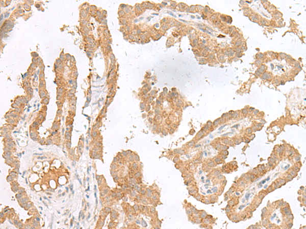Immunohistochemistry of paraffin-embedded Human thyroid cancer tissue  using CXCL6 Polyclonal Antibody at dilution of 1:45(×200)