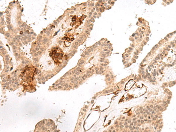 Immunohistochemistry of paraffin-embedded Human thyroid cancer tissue  using GRASP Polyclonal Antibody at dilution of 1:60(×200)