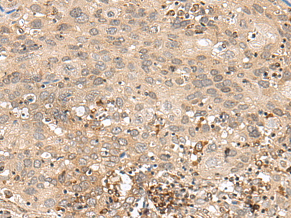Immunohistochemistry of paraffin-embedded Human cervical cancer tissue  using GFI1 Polyclonal Antibody at dilution of 1:60(×200)