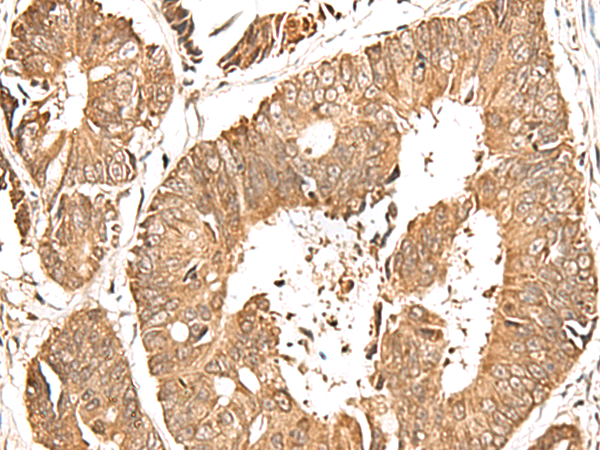 Immunohistochemistry of paraffin-embedded Human colorectal cancer tissue  using GFI1 Polyclonal Antibody at dilution of 1:60(×200)