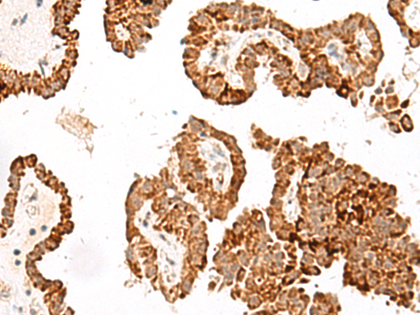Immunohistochemistry of paraffin-embedded Human thyroid cancer tissue  using GFI1B Polyclonal Antibody at dilution of 1:40(×200)
