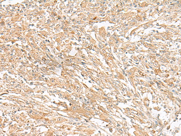 Immunohistochemistry of paraffin-embedded Human liver cancer tissue  using GIPC1 Polyclonal Antibody at dilution of 1:50(×200)