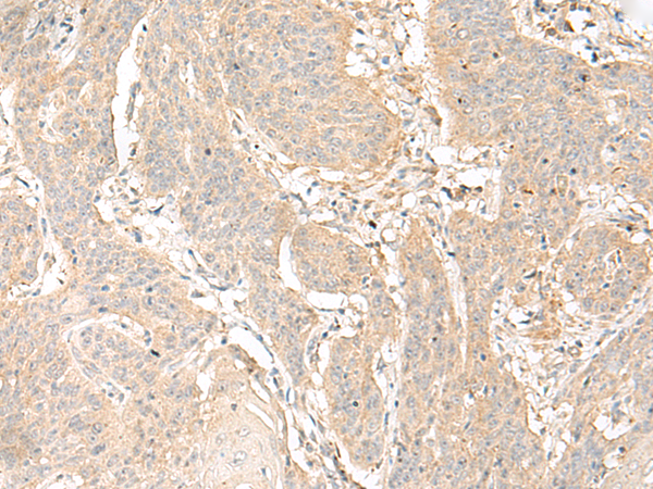 Immunohistochemistry of paraffin-embedded Human esophagus cancer tissue  using GLIS1 Polyclonal Antibody at dilution of 1:40(×200)