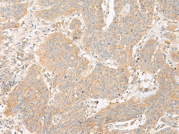 Immunohistochemistry of paraffin-embedded Human esophagus cancer tissue  using GP6 Polyclonal Antibody at dilution of 1:40(×200)