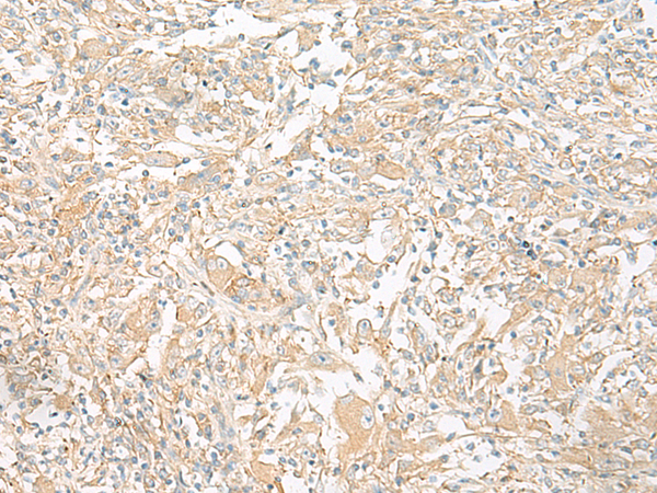Immunohistochemistry of paraffin-embedded Human liver cancer tissue  using GP6 Polyclonal Antibody at dilution of 1:40(×200)