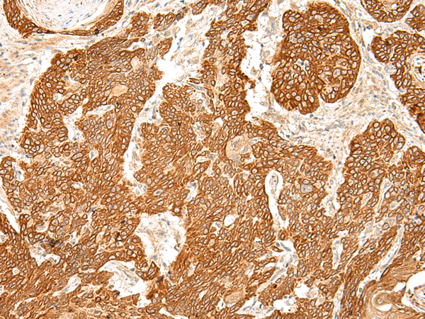 Immunohistochemistry of paraffin-embedded Human esophagus cancer tissue  using SLC6A9 Polyclonal Antibody at dilution of 1:50(×200)