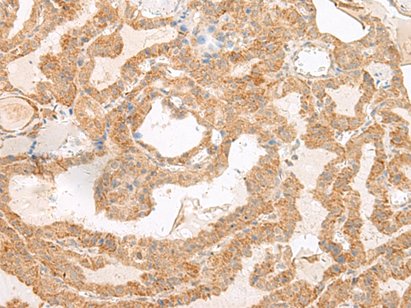 Immunohistochemistry of paraffin-embedded Human thyroid cancer tissue  using SLC6A9 Polyclonal Antibody at dilution of 1:50(×200)