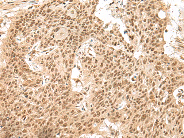 Immunohistochemistry of paraffin-embedded Human esophagus cancer tissue  using GMEB2 Polyclonal Antibody at dilution of 1:30(×200)