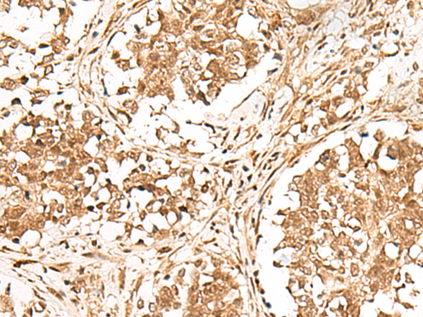 Immunohistochemistry of paraffin-embedded Human lung cancer tissue  using GMEB2 Polyclonal Antibody at dilution of 1:30(×200)