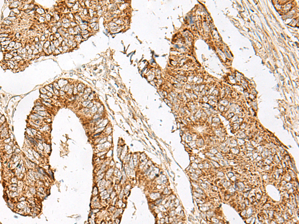 Immunohistochemistry of paraffin-embedded Human colorectal cancer tissue  using GNAT1 Polyclonal Antibody at dilution of 1:25(×200)