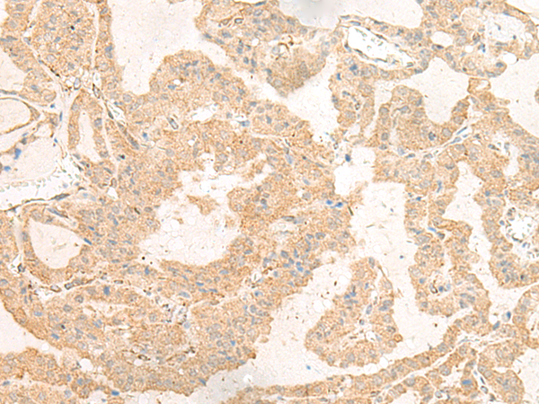 Immunohistochemistry of paraffin-embedded Human thyroid cancer tissue  using GNAT3 Polyclonal Antibody at dilution of 1:40(×200)