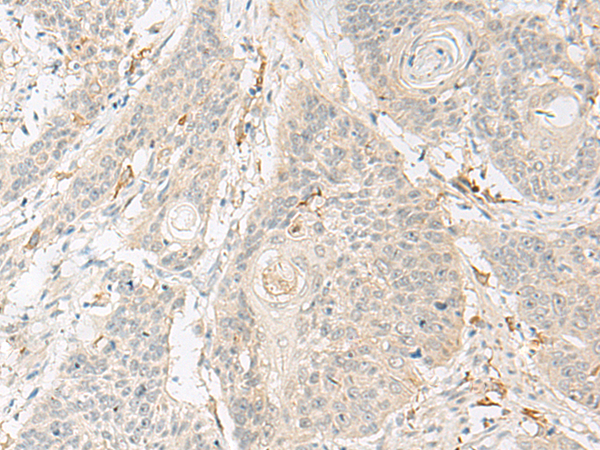 Immunohistochemistry of paraffin-embedded Human esophagus cancer tissue  using GNAT3 Polyclonal Antibody at dilution of 1:40(×200)