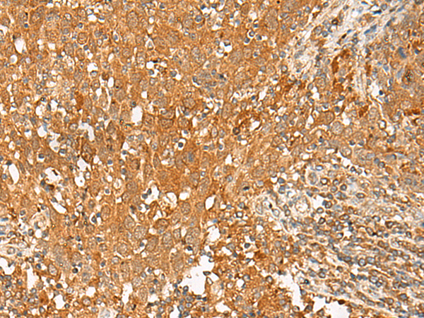 Immunohistochemistry of paraffin-embedded Human cervical cancer tissue  using GPR1 Polyclonal Antibody at dilution of 1:50(×200)