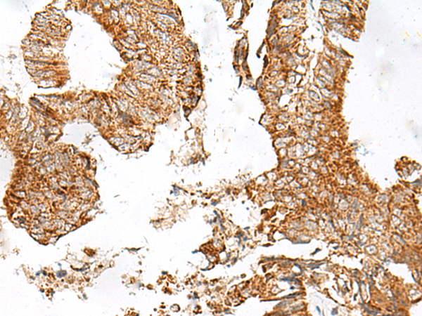 Immunohistochemistry of paraffin-embedded Human colorectal cancer tissue  using GPR119 Polyclonal Antibody at dilution of 1:45(×200)