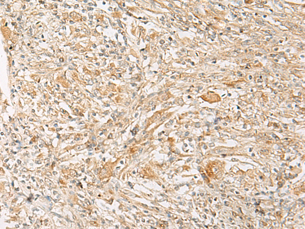 Immunohistochemistry of paraffin-embedded Human liver cancer tissue  using GPR22 Polyclonal Antibody at dilution of 1:50(×200)