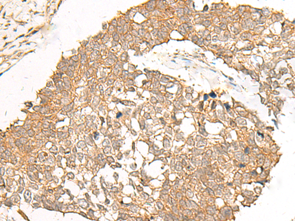 Immunohistochemistry of paraffin-embedded Human lung cancer tissue  using POLR2L Polyclonal Antibody at dilution of 1:40(×200)