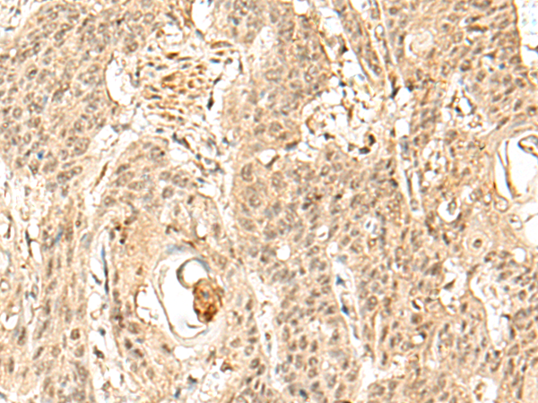 Immunohistochemistry of paraffin-embedded Human esophagus cancer tissue  using SNAPC5 Polyclonal Antibody at dilution of 1:30(×200)