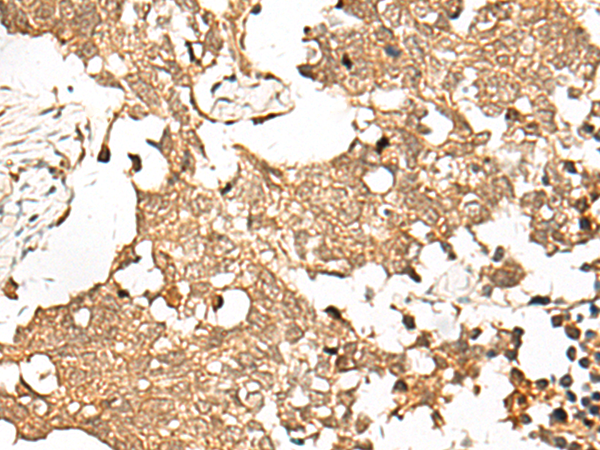 Immunohistochemistry of paraffin-embedded Human lung cancer tissue  using SNAPC5 Polyclonal Antibody at dilution of 1:30(×200)