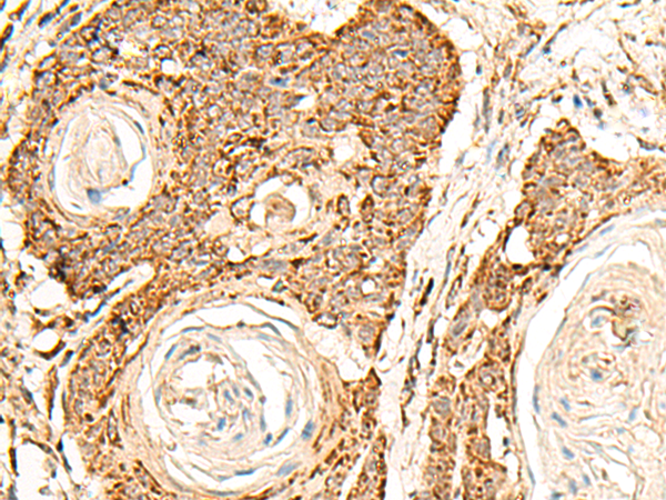 Immunohistochemistry of paraffin-embedded Human esophagus cancer tissue  using ATP5I Polyclonal Antibody at dilution of 1:30(×200)