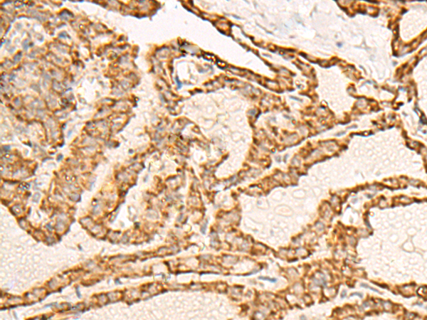 Immunohistochemistry of paraffin-embedded Human thyroid cancer tissue  using ATP5I Polyclonal Antibody at dilution of 1:30(×200)