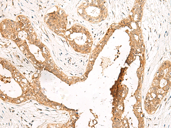 Immunohistochemistry of paraffin-embedded Human breast cancer tissue  using LDHA Polyclonal Antibody at dilution of 1:40(×200)