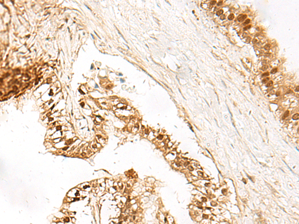 Immunohistochemistry of paraffin-embedded Human liver cancer tissue  using LDHA Polyclonal Antibody at dilution of 1:40(×200)