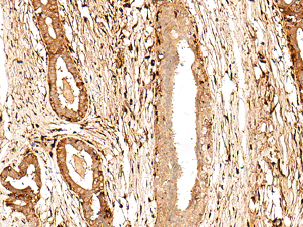 Immunohistochemistry of paraffin-embedded Human breast cancer tissue  using GPR27 Polyclonal Antibody at dilution of 1:60(×200)