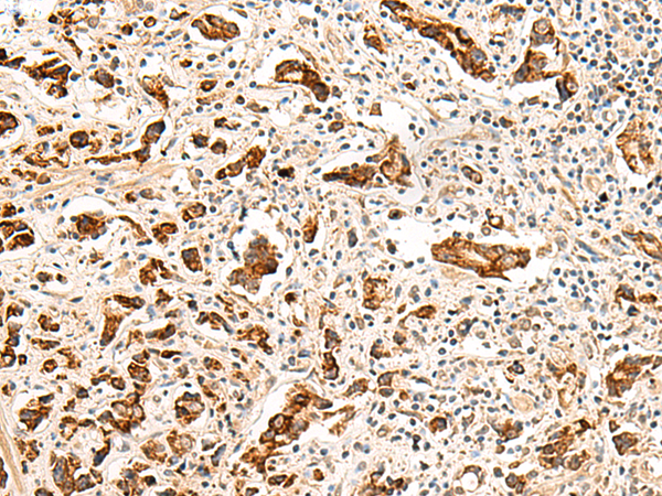 Immunohistochemistry of paraffin-embedded Human prost at e cancer tissue  using GPR160 Polyclonal Antibody at dilution of 1:35(×200)