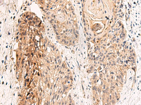 Immunohistochemistry of paraffin-embedded Human esophagus cancer tissue  using GPR152 Polyclonal Antibody at dilution of 1:45(×200)